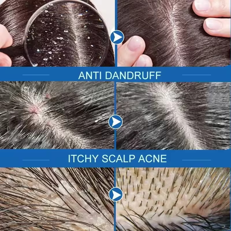 Fast Anti Dandruff Hair Treatm - огляд і ціна Hair Care Dandruff